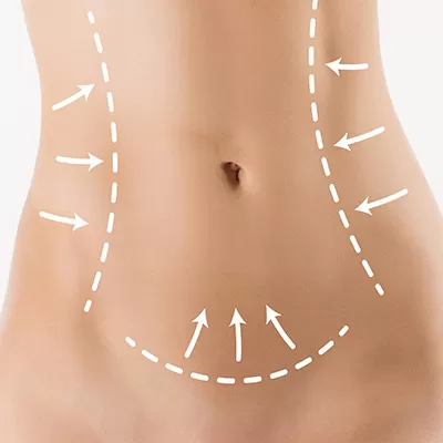 Lipoaspiração